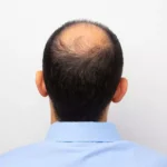 Des remèdes contre la perte de cheveux